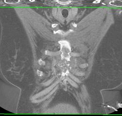 Post Mediastinal Surgery With Osteomyelitis - CTisus CT Scan