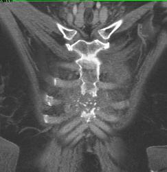 Post Mediastinal Surgery With Osteomyelitis - CTisus CT Scan