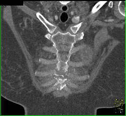 Post Mediastinal Surgery With Osteomyelitis - CTisus CT Scan