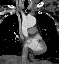 Dissection Extends Into the Left Carotid Artery - CTisus CT Scan