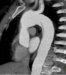 Dissection Extends Into the Left Carotid Artery - CTisus CT Scan