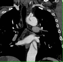 Dissection Extends Into the Left Carotid Artery - CTisus CT Scan