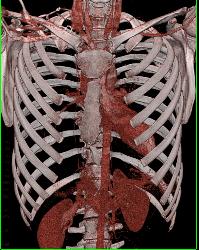 Pectus Deformity - CTisus CT Scan