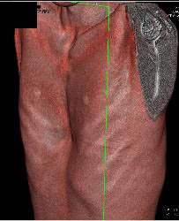 Pectus Deformity - CTisus CT Scan