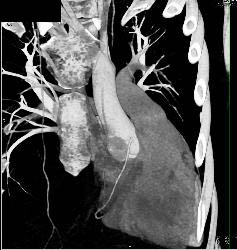 Pectus Deformity - CTisus CT Scan