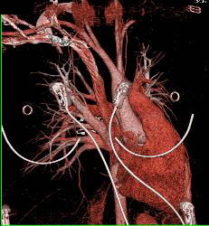 Gated Normal Ascending Aorta - CTisus CT Scan