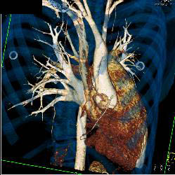 Gated Normal Ascending Aorta - CTisus CT Scan