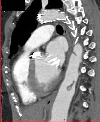 Thrombi in Aorta - CTisus CT Scan