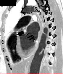 Thrombi in Aorta - CTisus CT Scan
