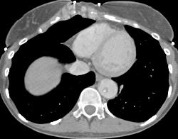 Thrombi in Aorta - CTisus CT Scan