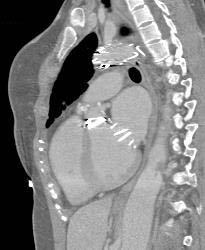 Aortic Valve Replacement (AVR) and MVR and Stent in SMA - CTisus CT Scan