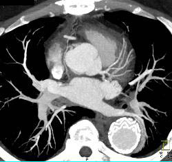 Endovascular Stent in Descending Aorta - CTisus CT Scan