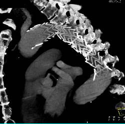 Endovascular Stent in Descending Aorta - CTisus CT Scan