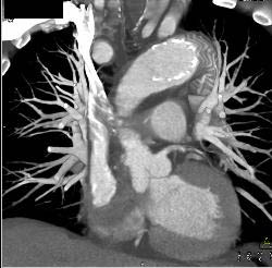 Endovascular Stent in Descending Aorta - CTisus CT Scan