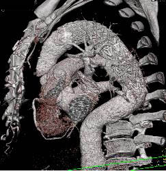 Endovascular Stent in Descending Aorta - CTisus CT Scan