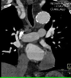 Endovascular Stent in Descending Aorta - CTisus CT Scan