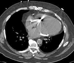 Pericardial Calcification - CTisus CT Scan