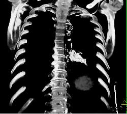 Pericardial Calcification - CTisus CT Scan