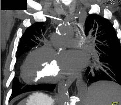 Pericardial Calcification - CTisus CT Scan