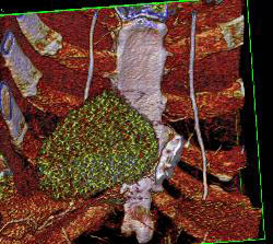 Pericardial Calcification - CTisus CT Scan