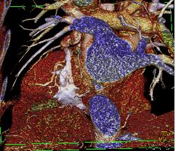 Pericardial Calcification - CTisus CT Scan