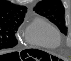 Pericardial Calcification - CTisus CT Scan