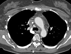 Pulmonary Embolism (PE) and SVC Occlusion Due to Tumor - CTisus CT Scan