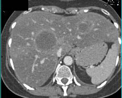 Pulmonary Embolism (PE) and SVC Occlusion Due to Tumor - CTisus CT Scan