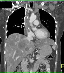 Pulmonary Embolism (PE) and SVC Occlusion Due to Tumor - CTisus CT Scan