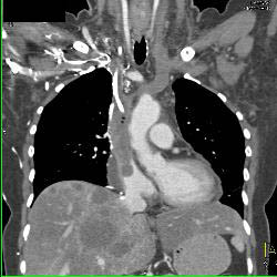 Pulmonary Embolism (PE) and SVC Occlusion Due to Tumor - CTisus CT Scan