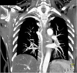 Pulmonary Embolism (PE) and SVC Occlusion Due to Tumor - CTisus CT Scan