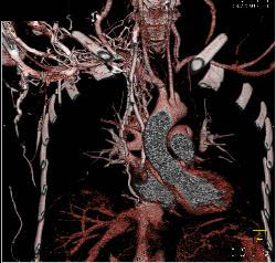 SVC Occlusion With Collaterals - CTisus CT Scan