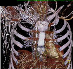 SVC Occlusion With Collaterals - CTisus CT Scan