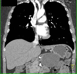 Patent SVC - CTisus CT Scan