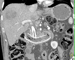 Will Replace - CTisus CT Scan