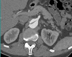 Will Replace - CTisus CT Scan