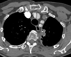 Arch Vessels Involved in Dissection - CTisus CT Scan