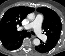 Arch Vessels Involved in Dissection - CTisus CT Scan