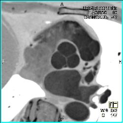 Normal Aortic Valve - CTisus CT Scan