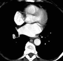 Pseudoflap in Left Atrium - CTisus CT Scan