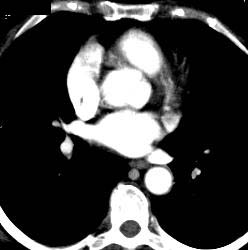 Pseudoflap in Left Atrium - CTisus CT Scan