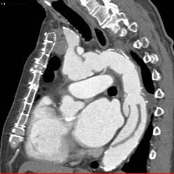 Type A Dissection With Repair Extends Into the Left Carotid Artery - CTisus CT Scan