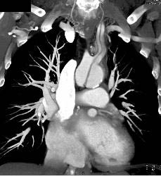 Type A Dissection With Repair Extends Into the Left Carotid Artery - CTisus CT Scan