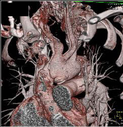 Type A Dissection With Repair Extends Into the Left Carotid Artery - CTisus CT Scan