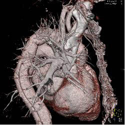 Type A Dissection With Repair Extends Into the Left Carotid Artery - CTisus CT Scan