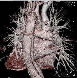 Type A Dissection With Repair Extends Into the Left Carotid Artery - CTisus CT Scan