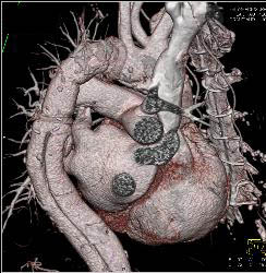 Type A Dissection With Repair Extends Into the Left Carotid Artery - CTisus CT Scan