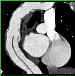 Type A Dissection With Repair Extends Into the Left Carotid Artery - CTisus CT Scan