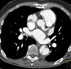 Type A Dissection With Repair Extends Into the Left Carotid Artery - CTisus CT Scan