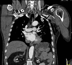 Stab Wound With Broken Blade in Chest Causing Artifact - CTisus CT Scan